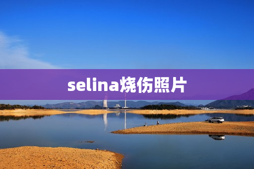 selina烧伤照片
